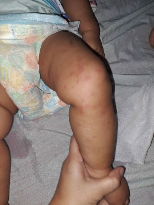 Heat rashes or tigdas