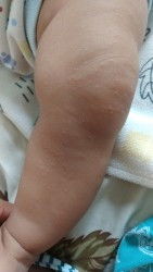 Bruntusa Seluruh badan