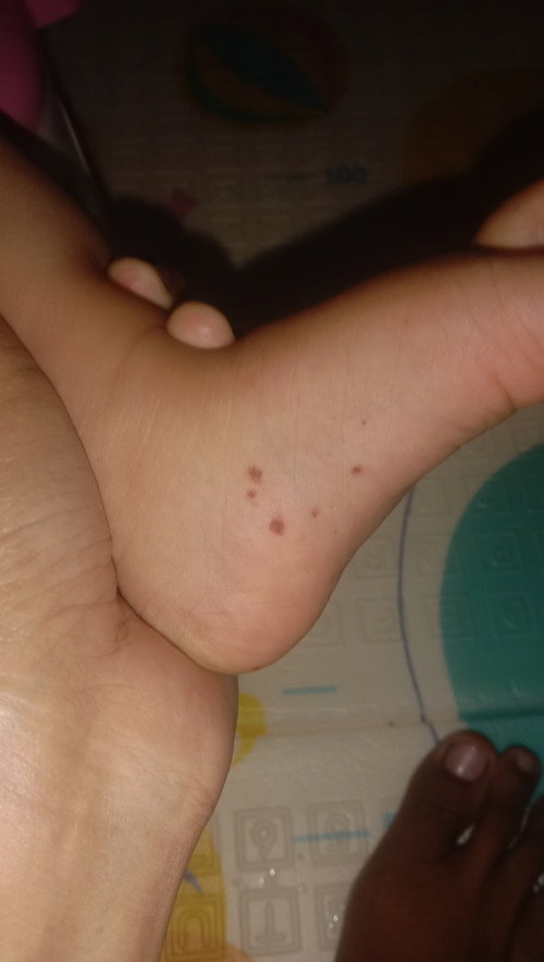 Bercak merah kecoklatan pada bayi