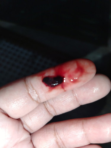 dinugo ng 2 days pero nag stop