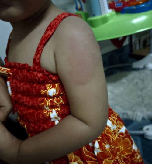 ผื่น  ปวมแดง  หลังฉีดวัคซีน 1ปีครึ่ง