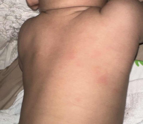 What kind of rash is this?