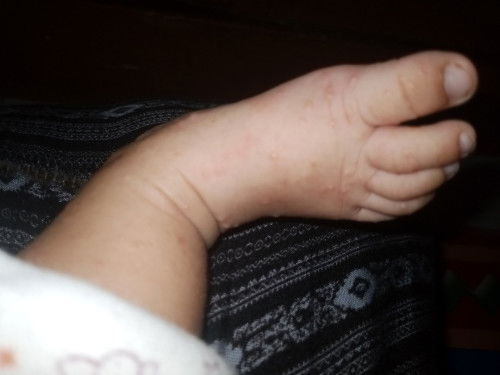 Baby ku usia 2 bulan tapi kek kuman air gituu, obatin pake apa ya?