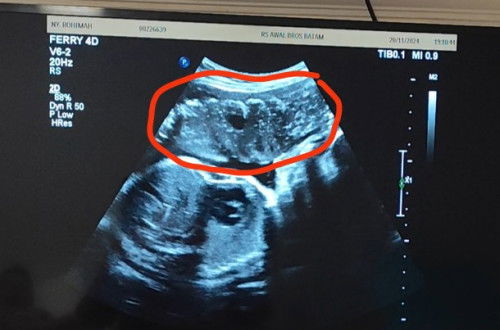 Pengapuran Plasenta 31w