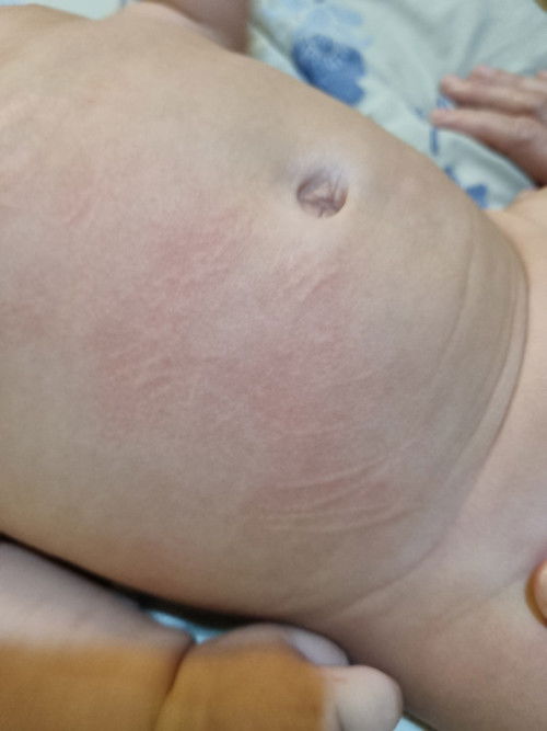 Kulit kemerahan saat mandi