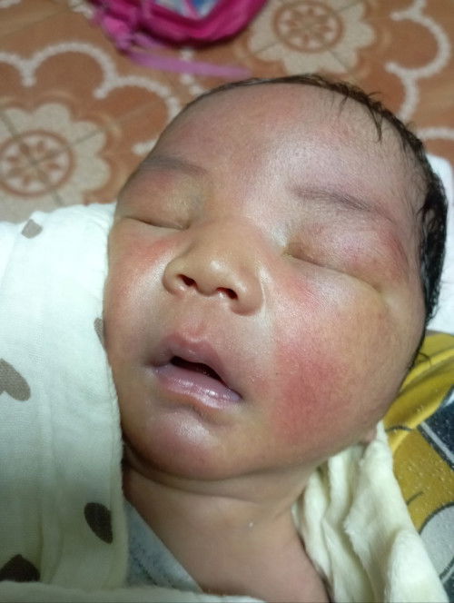 มีแม่ๆคนไหนเลี้ยงลูกแล้วหน้าแดงไปหมค่ะ