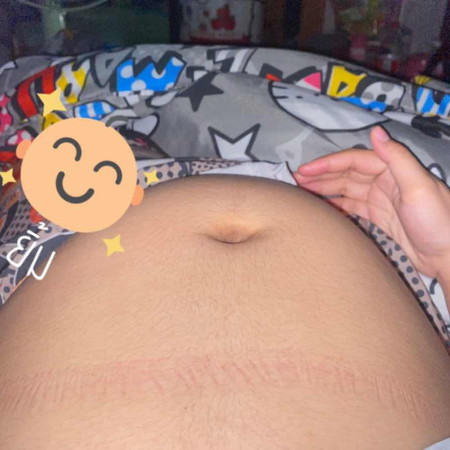 สอบถามแม่ๆค่ะท้องไปกองข้างล่างแล้วแข็งเป็นก้อนๆเกิดจากอะไรคะ