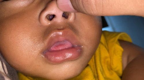 Didalam hidung ada benjolan