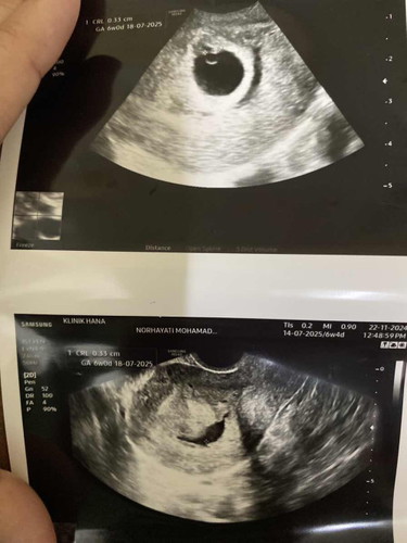 Pendarahan dinding rahim