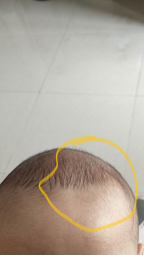 Ada yg pernah ngalamin,  jidat atas bayi cekung, kenapa ya? Apa termasuk bagian ubun²