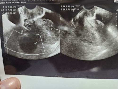 TP 5x positif, pas cek obgyn trnyata baru penebalan dinding rahim+kista 2cm😔 jd overthinking bun..