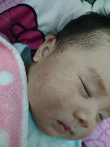 Cho e hỏi có mom nào con bị chàm sữa mà chữa khỏi không ạ, cho e phương pháp điều trị chàm sữa với ạ