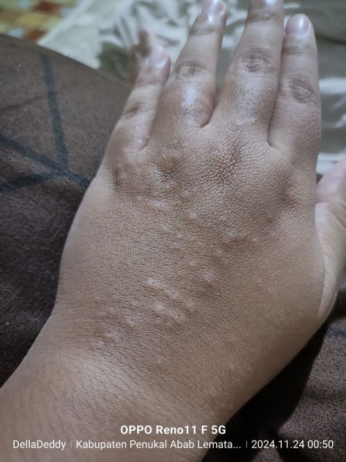 Gatal gatal dan tumbuh bentol kecil saat hamil TM 2