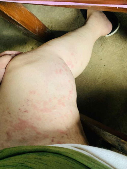 Skin Rashes 8months preggy