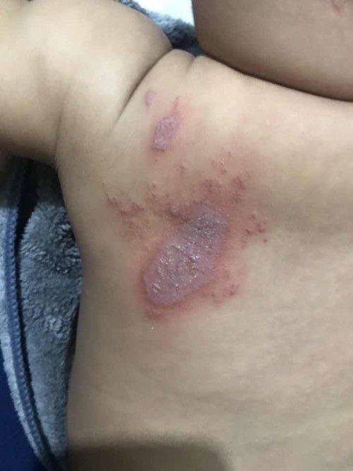 Permasalahan kulit bayi