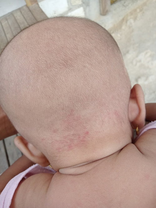 Tanda bercak merah dibelakang kepala bayi