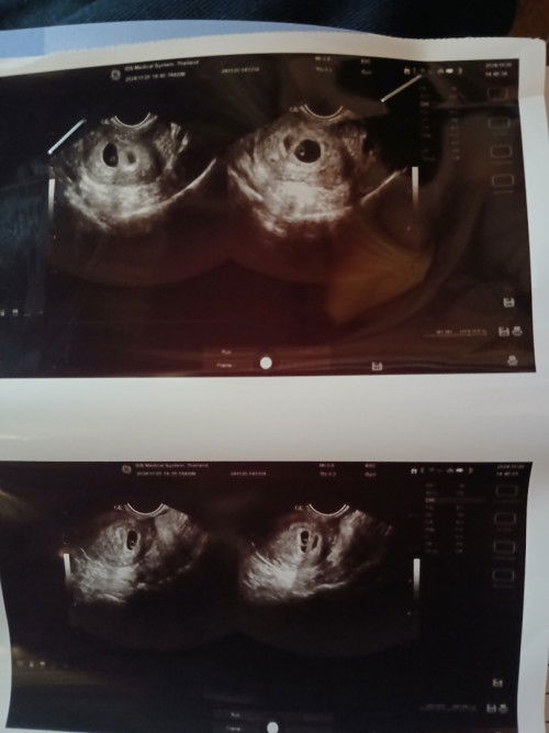 น้องเป็นแฝดค่ะแพ้ท้องหนักมาก