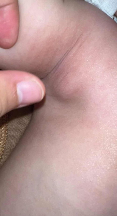 Benjolan di ketiak kanan bsyi