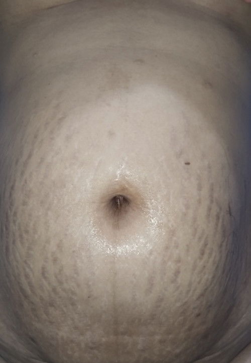 Stretchmark mulai memudar di usia 7 bulan pasca kelahiran