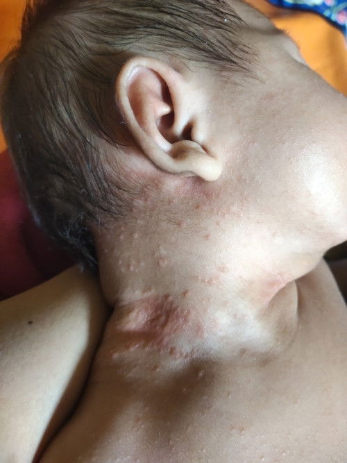 Bagi pengalaman nya bun atasi ruam nya