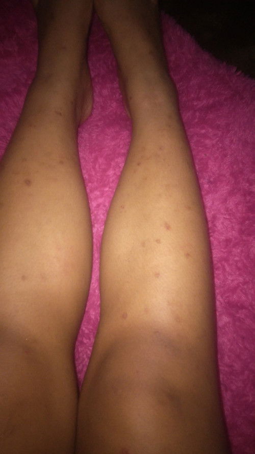 Gatal-gatal selama hamil