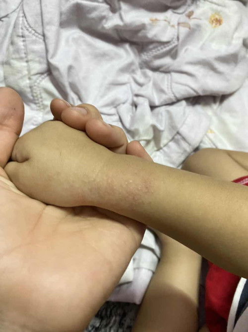 สอบถามข้อมือน้องมีผื่นค่ะ