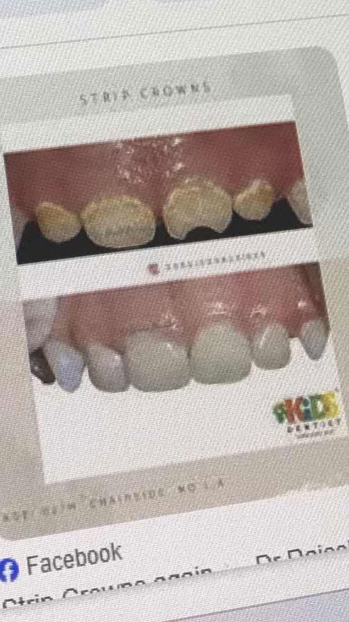 บ้านไหนลูกฟันผุบ้างคะทำยังไงกันบ้าง?