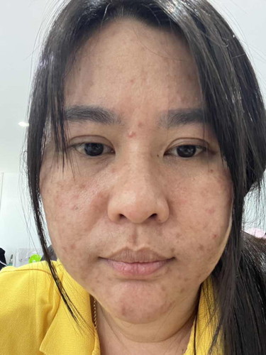 ท้องแรกค่ะตอนอายุ40ค่ะตอนนี้หน้าพังมากค่ะมีคำแนะนำบ้างไหมคะ