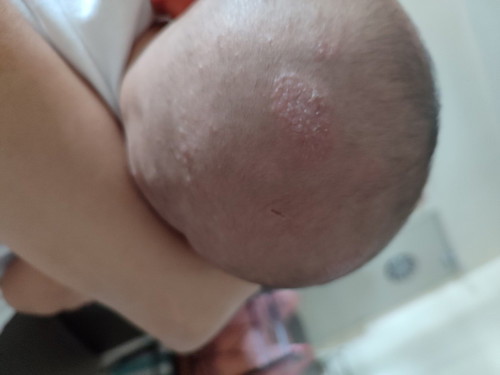 Ruam di muka dan kepala