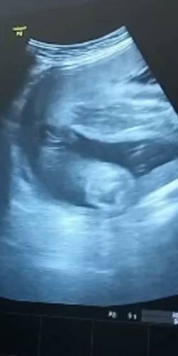 Baby's Gender Confused