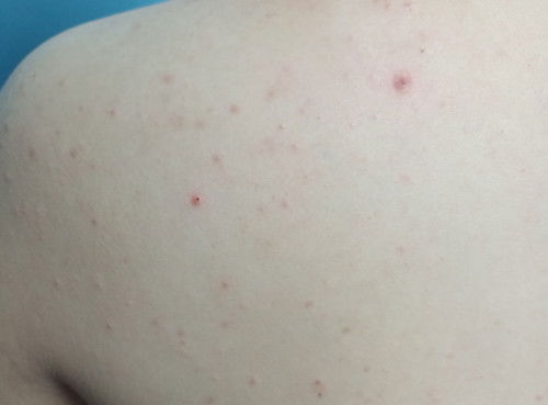 ท้องลูกชายคนแรก 29w สิวขึ้นหลังขนาดนี้ มันปกติไหมคะ ต้องหาหมอผิวหนังไหมคะ ทรมานมาก