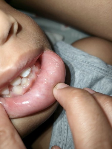 teeth cavity? need more input