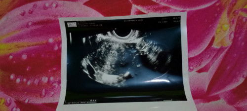 Kehamilan 3minggu( masuk 4minggu)