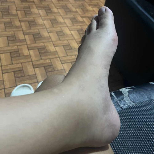 Nagsisimulang mamanas na paa