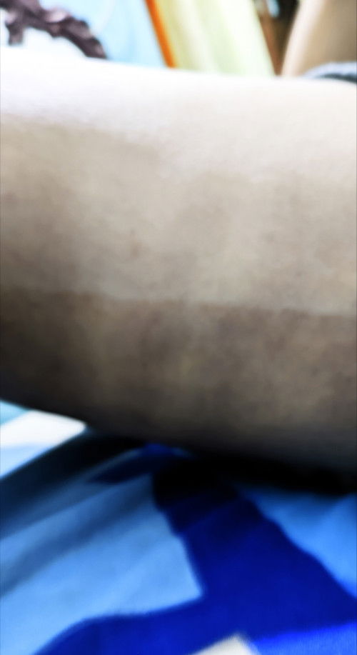 adakah bumil yang mengalami hal yang sama seperti saya? kulit jadi belang.jelas banget separuh badan