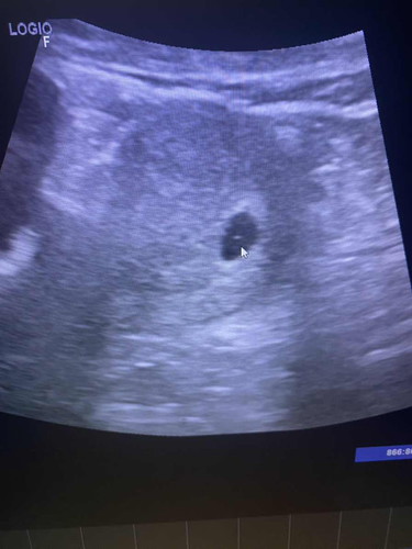 กังวลกลัวท้องลม