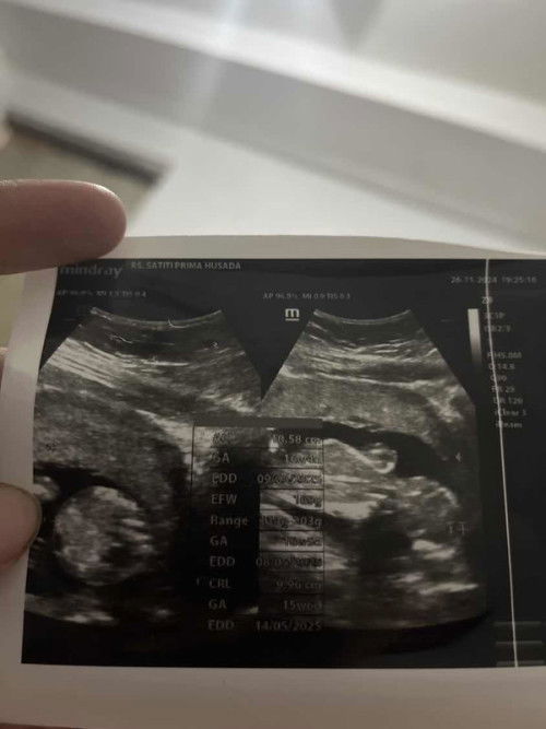 Bantu jawab hasil usg dong bund