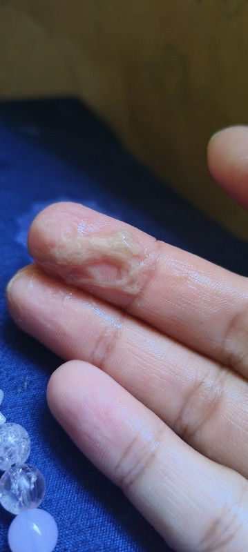 Hamil 11w keluar keputihan