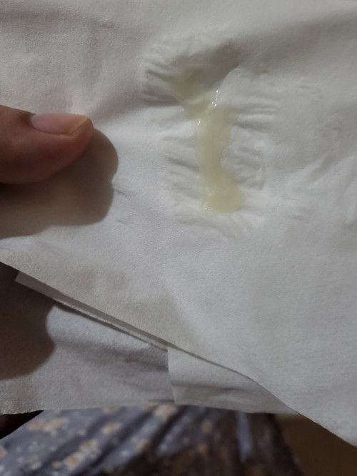 Parang sipon na discharge. Is it nothing to worry about?