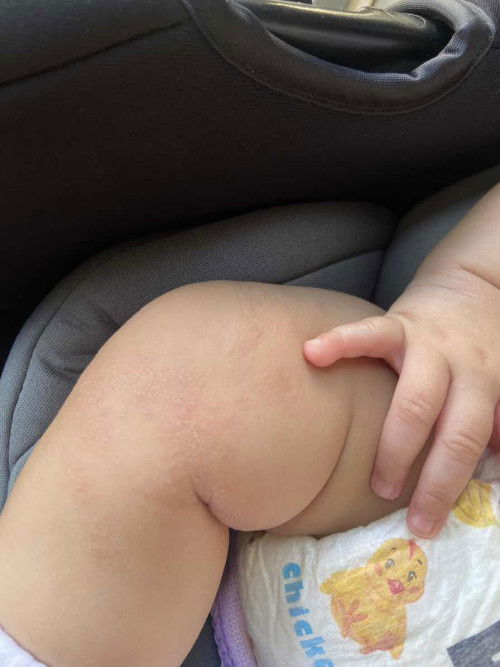 ปกติมั้ยคะ น้องเป็นผด