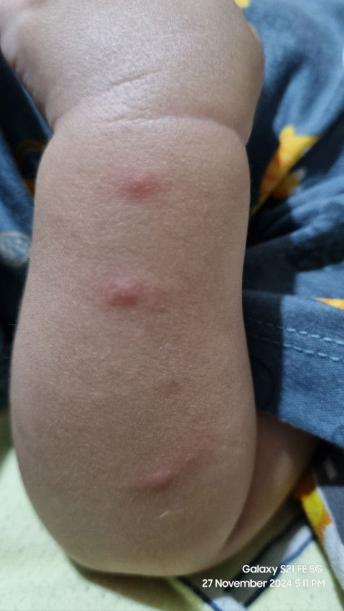 Salep u/gigitan nyamuk atau serangga u/bayi 6 bulan