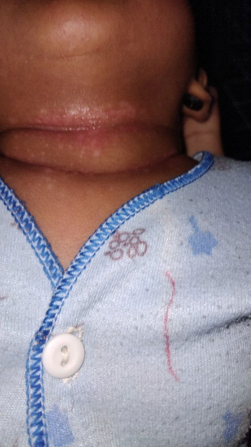 Ruam Di lipatan Leher