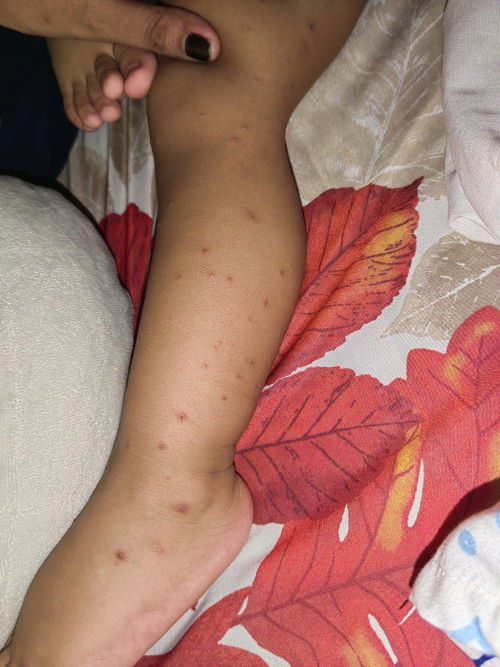 Skin Rashes or Allergy