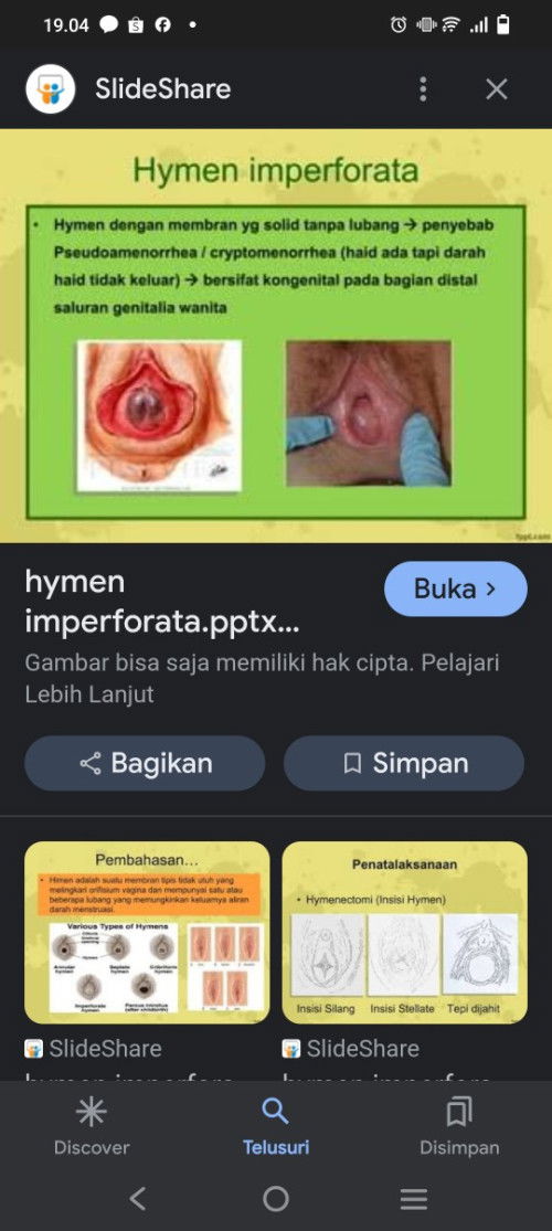 Muncul benjolan di bagian lubang tengah vagina