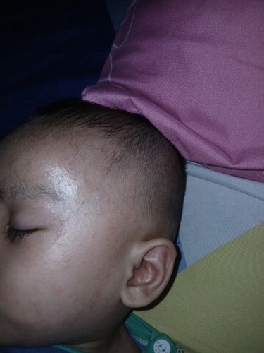 Bun maaf mau nanya,Ada ga anak bunda ruam² dimuka hampir tiap hari muncl.Dri bayi smpk 1thn g ilang²