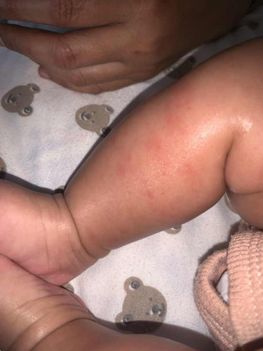 Tiba2 kulit bayi merah bercak bercak