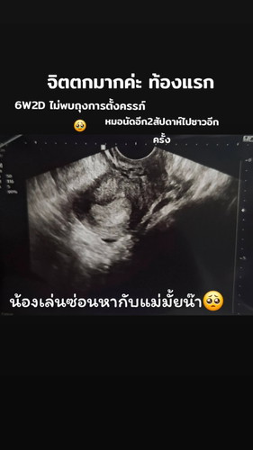 6W2D ไม่พบถุงตั้งครรภ์🥺