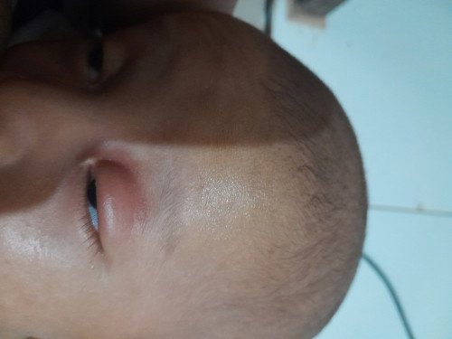Gigitan nyamuk