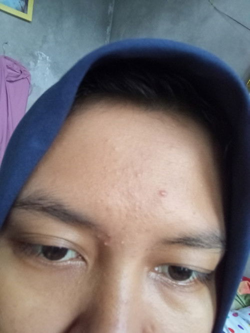 Jerawatan saat hamil TM 1