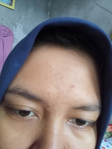 Jerawatan saat hamil TM 1
